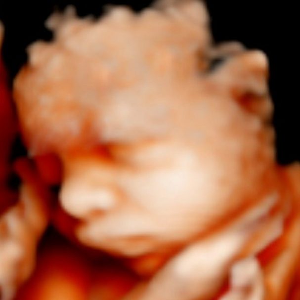 Feto en posición fetal, con detalles suaves y formas difusas.